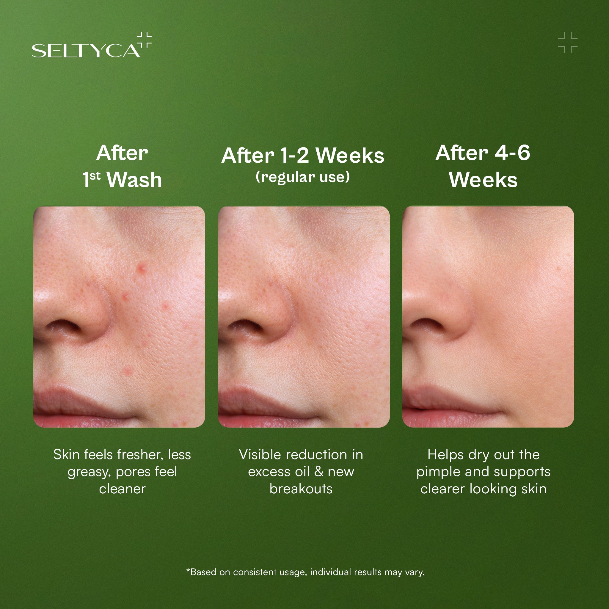 Foaming Acne Face Cleanser