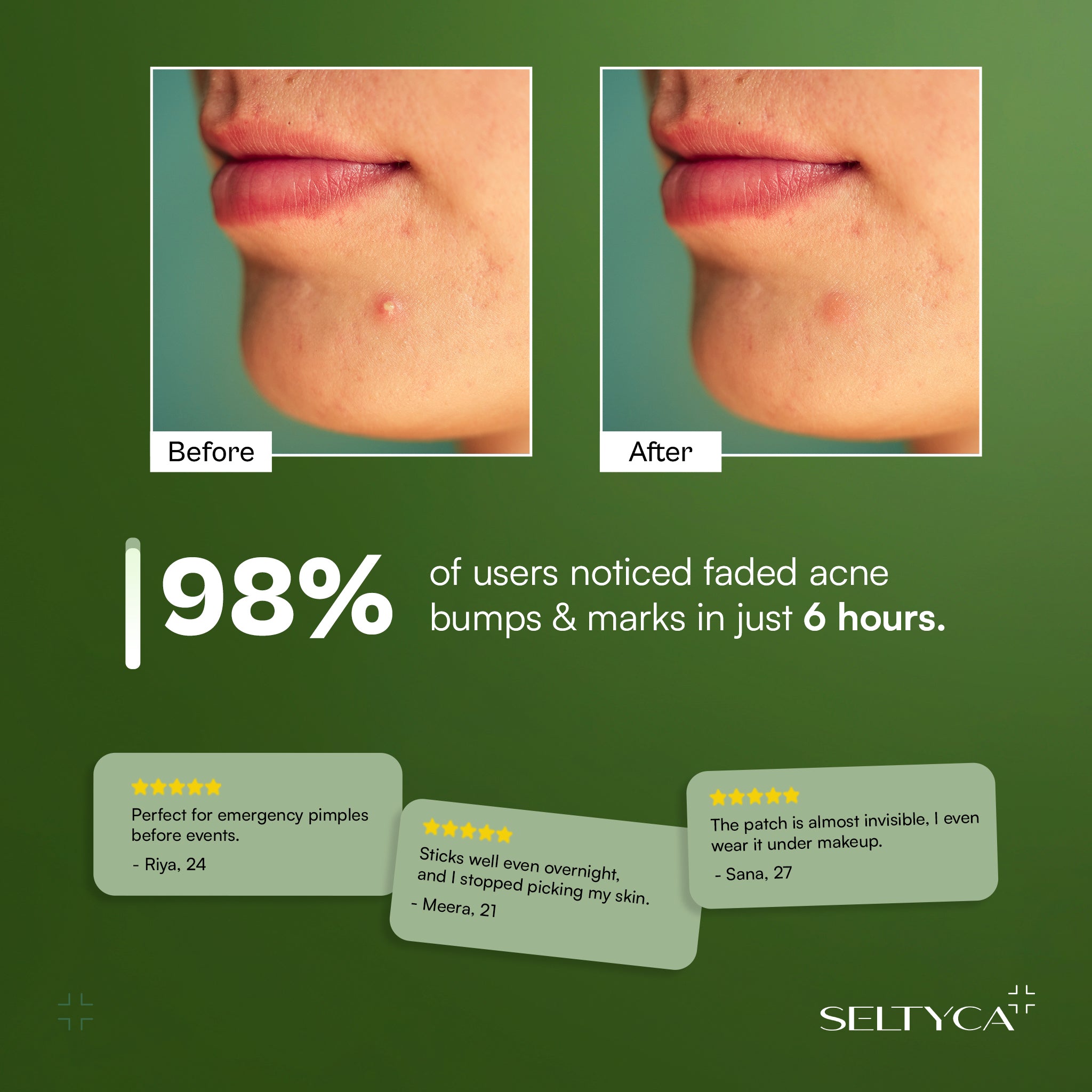 Seltyca Acne Dot Patch
