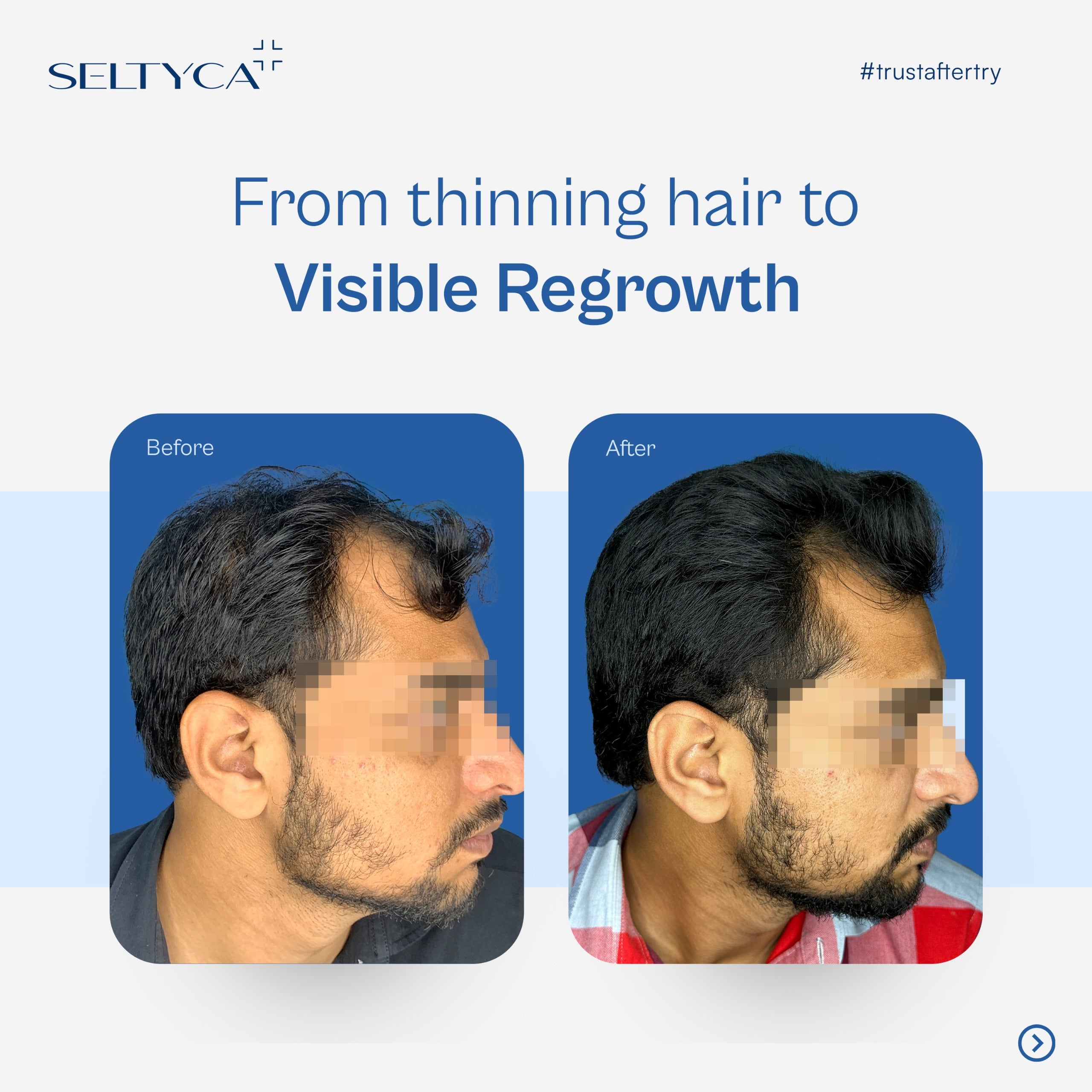 Seltyca Hair Fall Kit (No Dandruff)